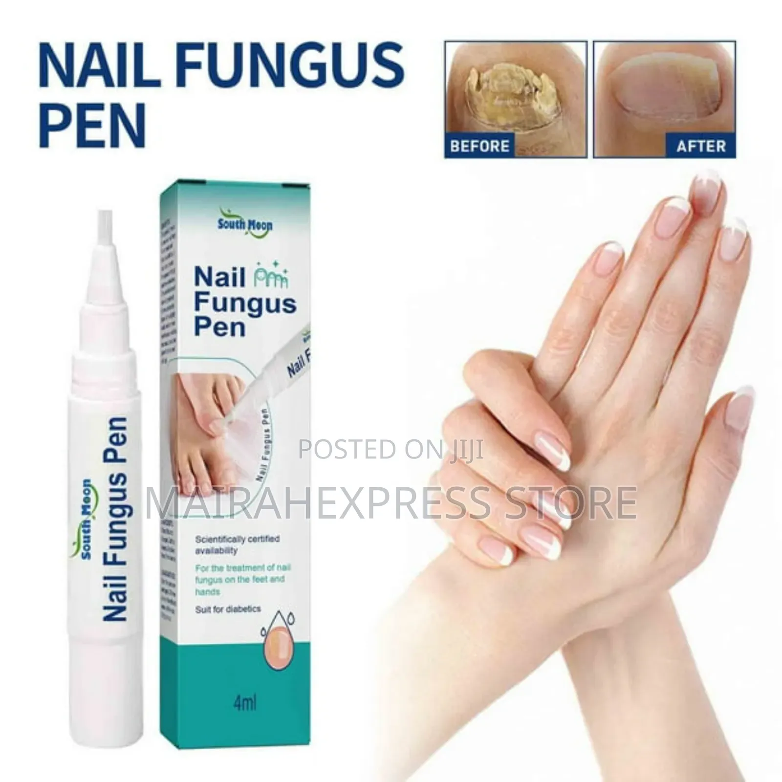 Southmoon Nail Fungus Pen (Cream) - Scientifically Certified Treatment