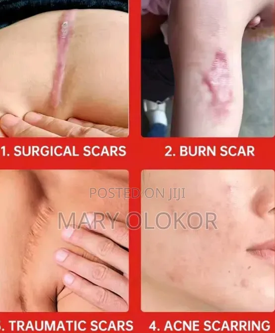 Sadoer Scar Repair Removal Cream