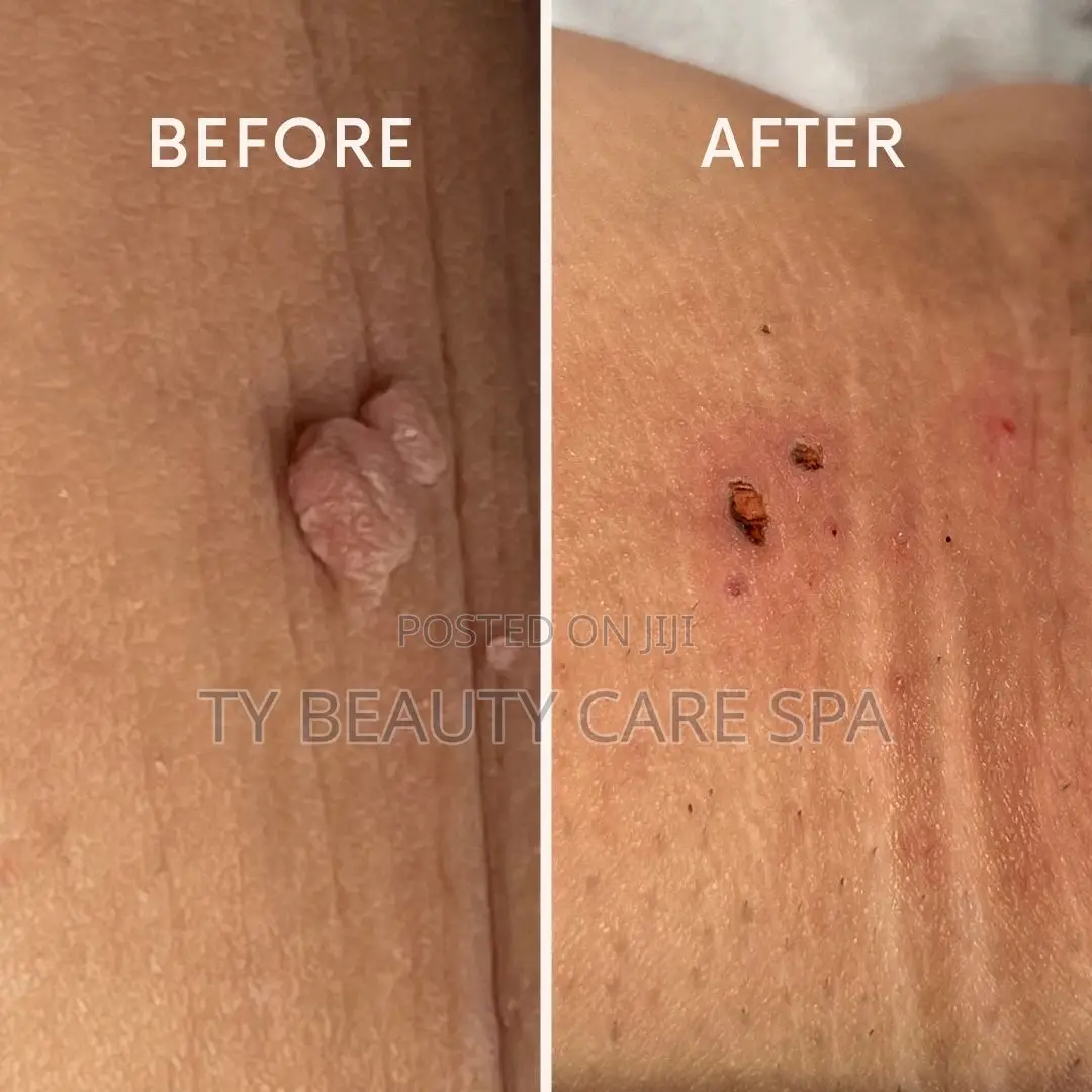 Skin Tags Removal
