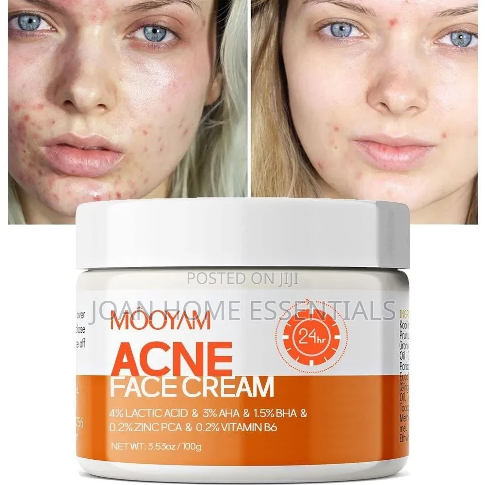 Acne Face Cream – Acne Treatment Dark Spot Removal Cream (100g)