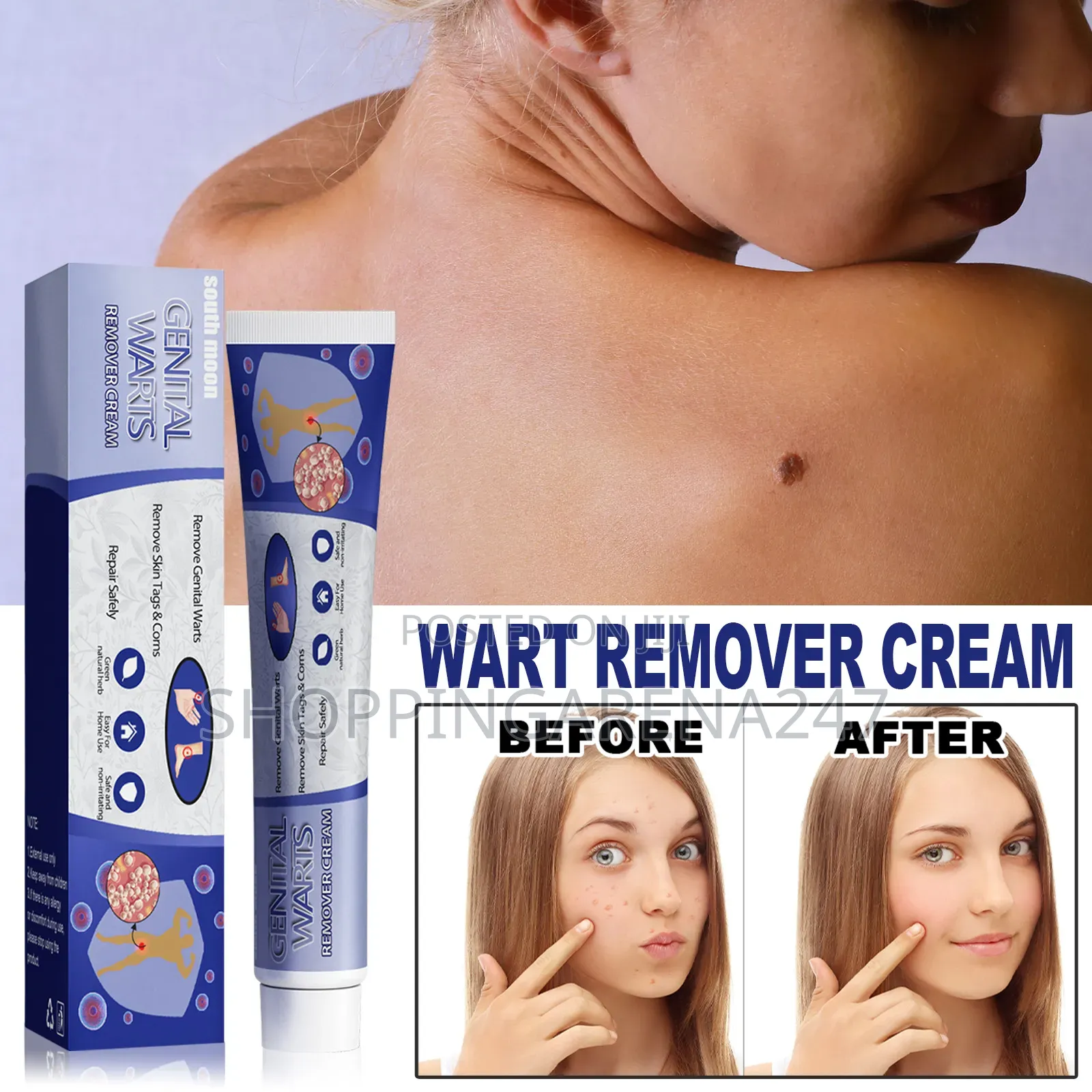 Skin Tag Common Warts Remover Ointment-20g