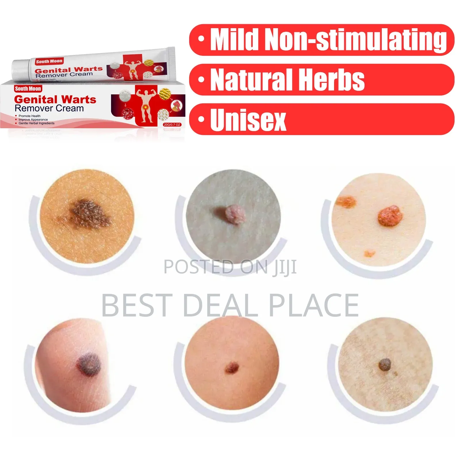 South Moon Genital Warts Removal Cream