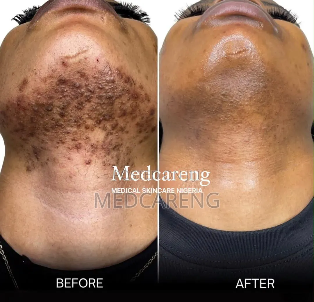 Laser/Permanent Hair Removal