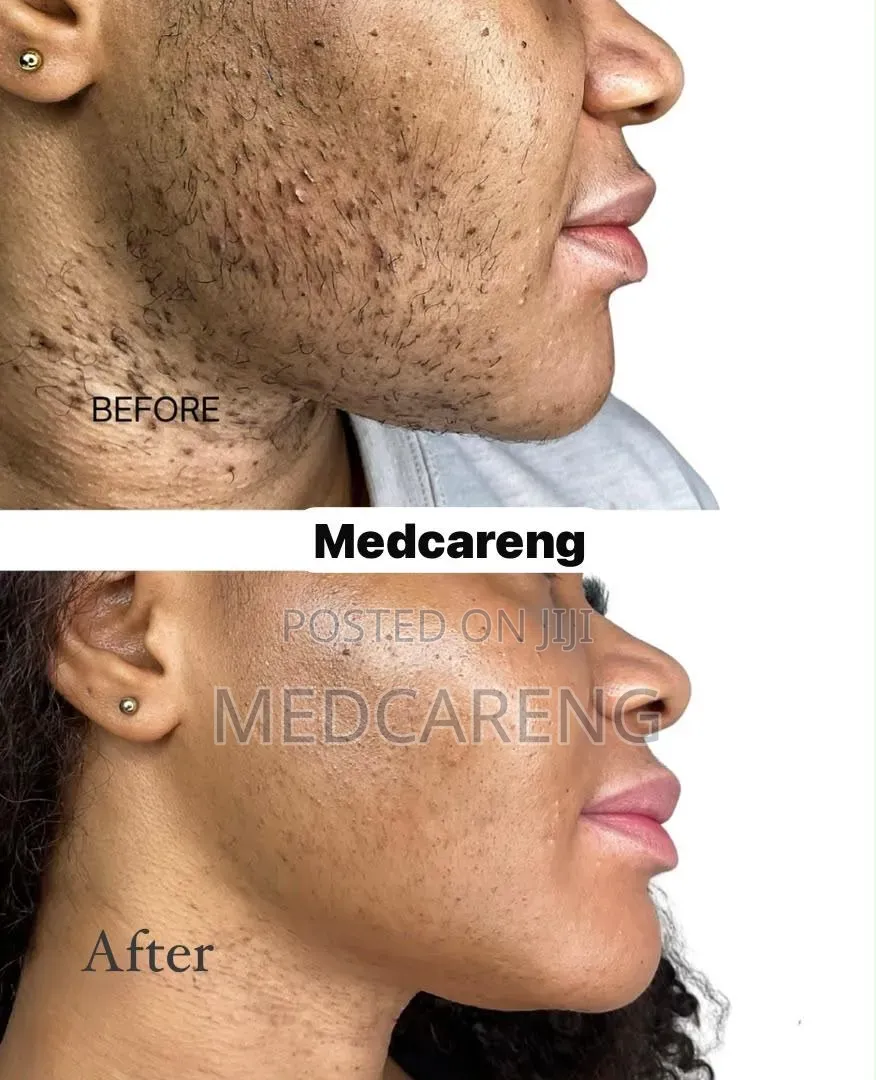 Laser/Permanent Hair Removal