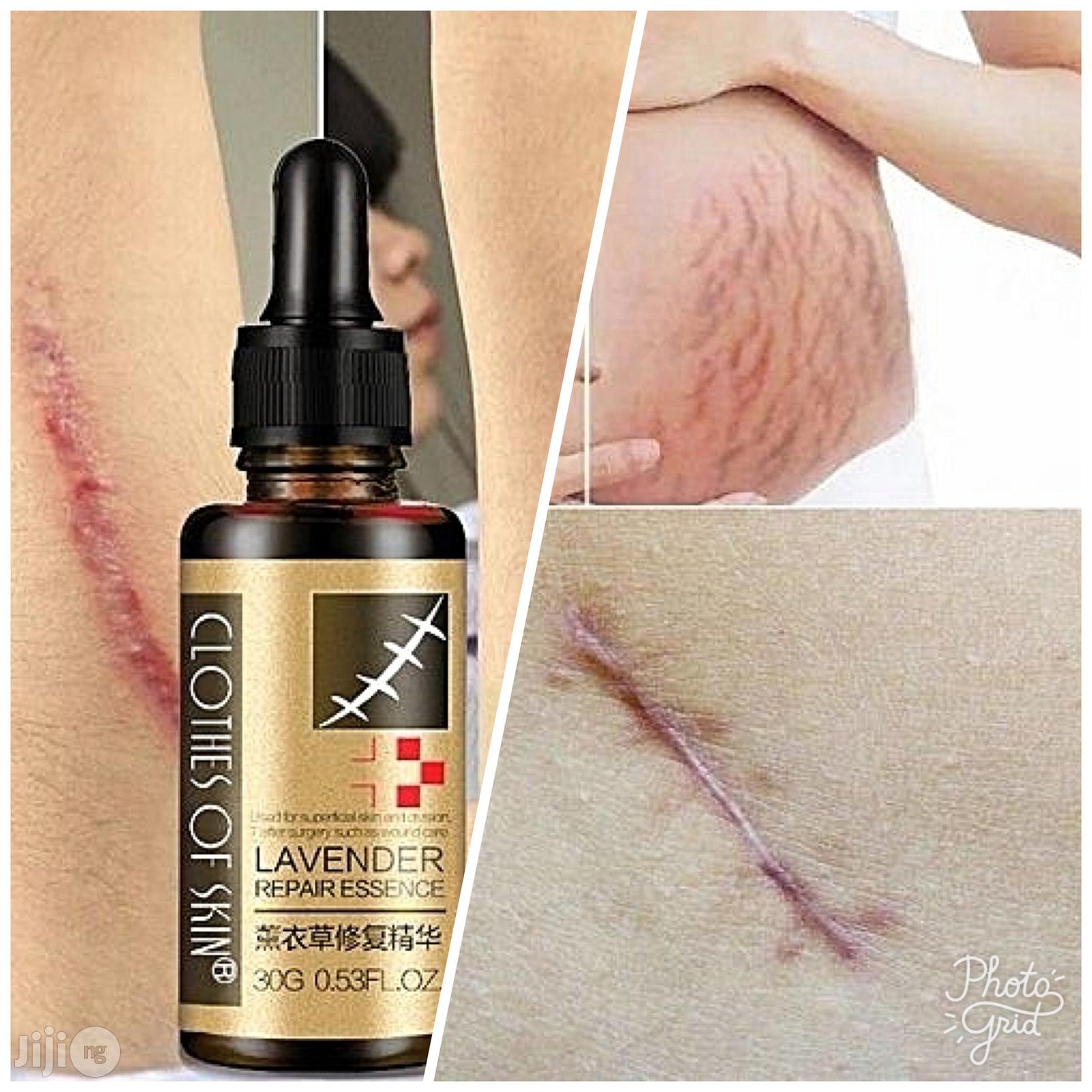 Wicked Scars And Stretch Marks Removal