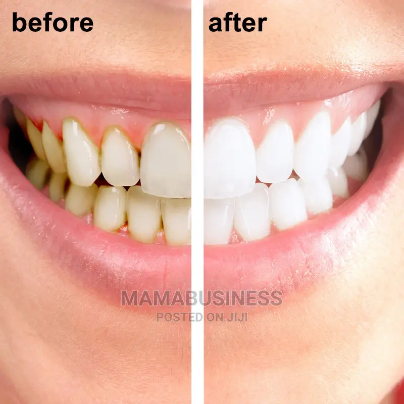 1 Minute – Teeth Whitening Teeth Cleaning Kit