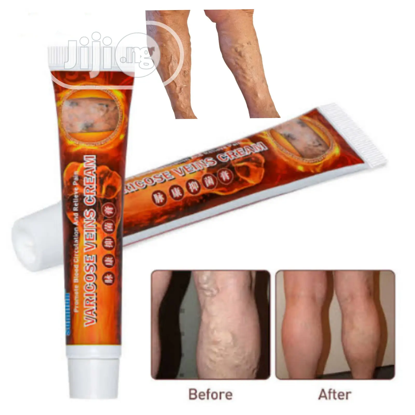 Varicose Vein Miraculous Cream