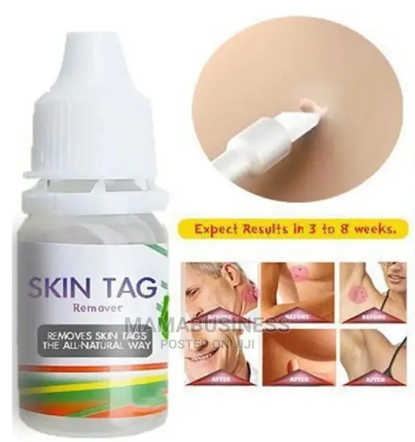 10g Skin Tag Remover Foot Corn Removal
