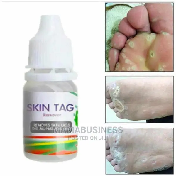 10g Skin Tag Remover Foot Corn Removal