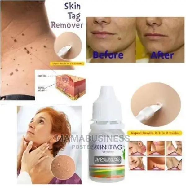 10g Skin Tag Remover Foot Corn Removal