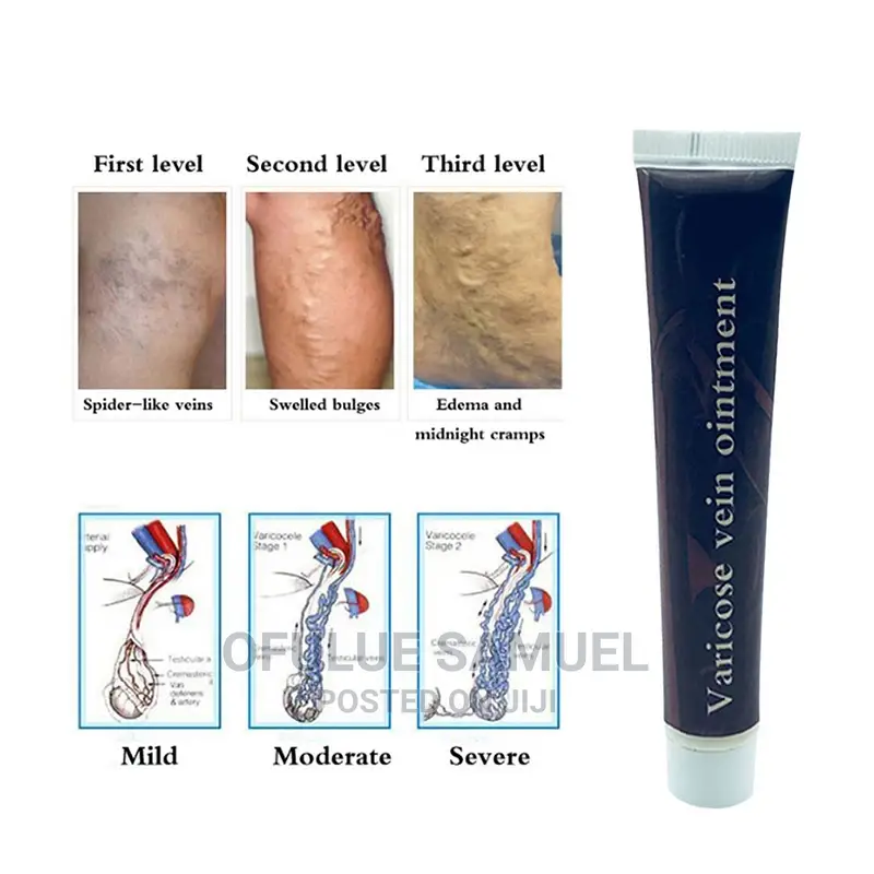 Varicose Vein Ointment