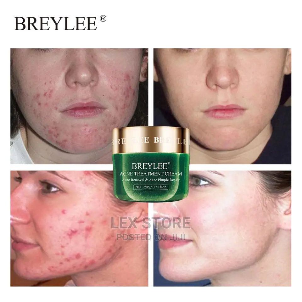 Breylee Acne Treatment Cream With Moq