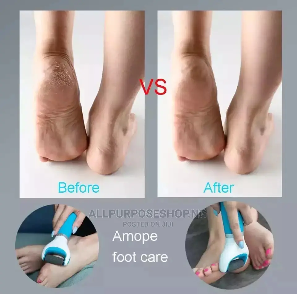 Rechargeable Callous Remover