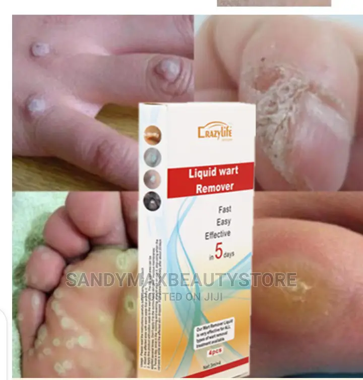 Liquid Wart And Skin Tag Remover
