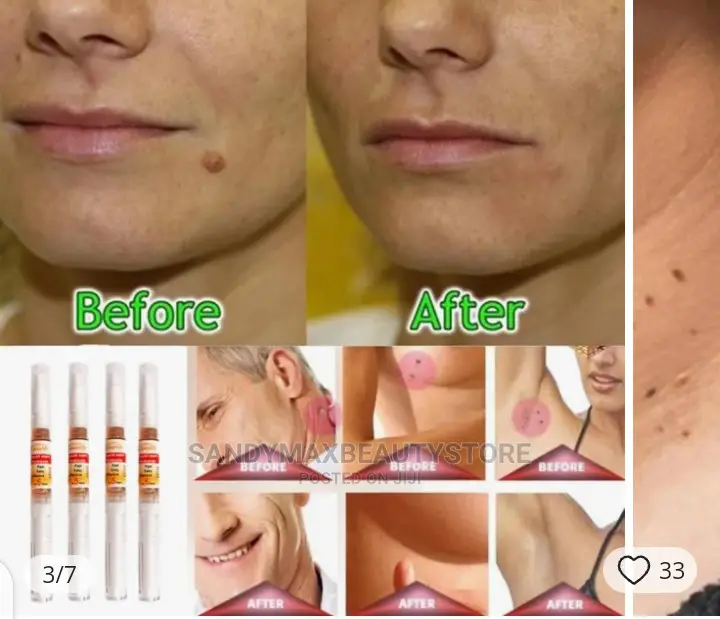 Liquid Wart And Skin Tag Remover